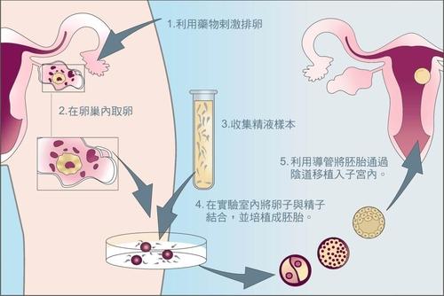 美国双胞胎借卵价格:美国试管婴儿的新标准是PGS与冷冻胚胎移植相结合。